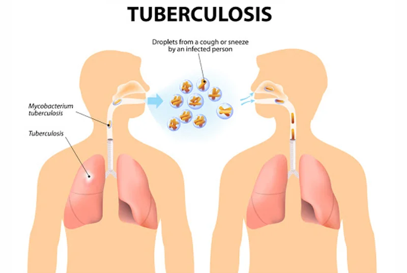 Tuberculosis